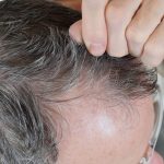Objawy i leczenie łysienia androgenowego